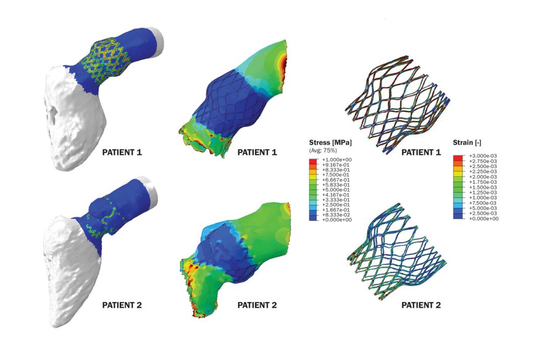 Comparison of patient-specific aortic-valve-frame results, frame-to-anatomy apposition (left column), anatomy stress response (center column) and valve-frame strain response (right column), 